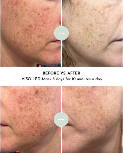 VISO Red Light Therapy Mask | FDA 510(k) Cleared